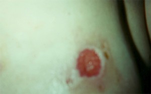 Breast Eschar Falls Off Breast Eschar Falls Off
