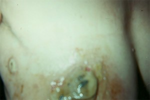 Eschars Form On Breast Eschars Form on Breast