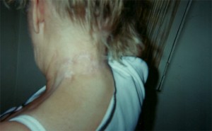 Neck Healed Neck Healed