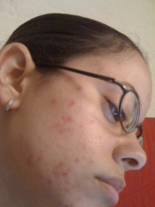Sazzu Hope Clears Acne Before Photo